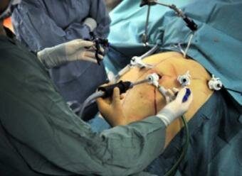 Bariatric Surgery may be helpful in fighting Diabetes Type 2