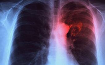 New study says new test can reduce TB related mortality